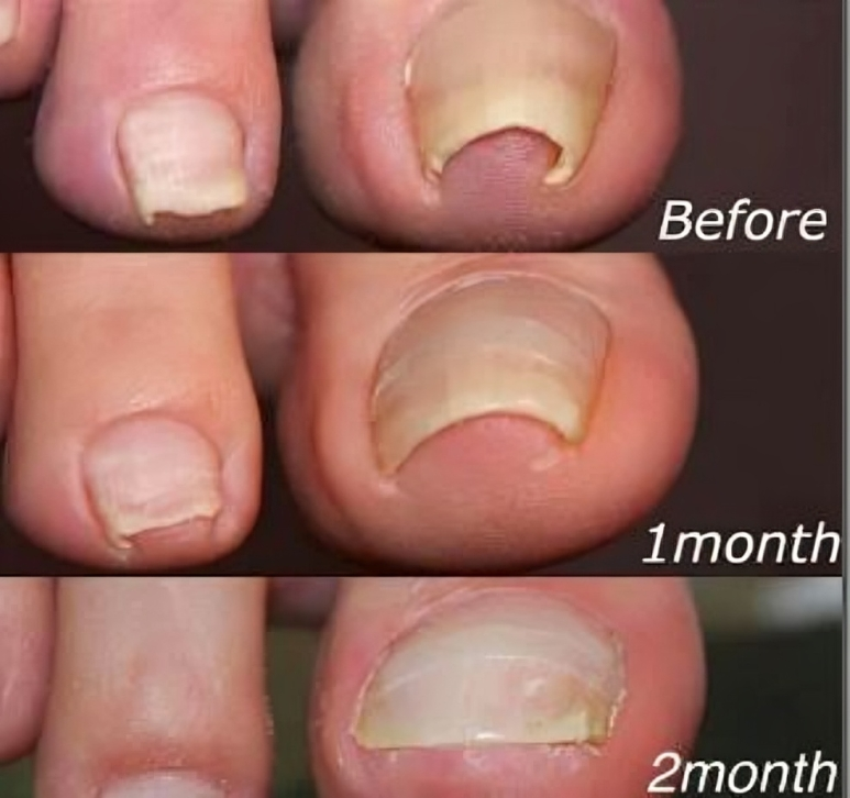 Correction patches for beautiful and healthy nails