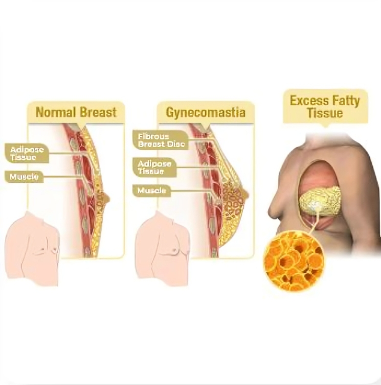 MenTherm Bee Venom Gynecomastia Heating Oil